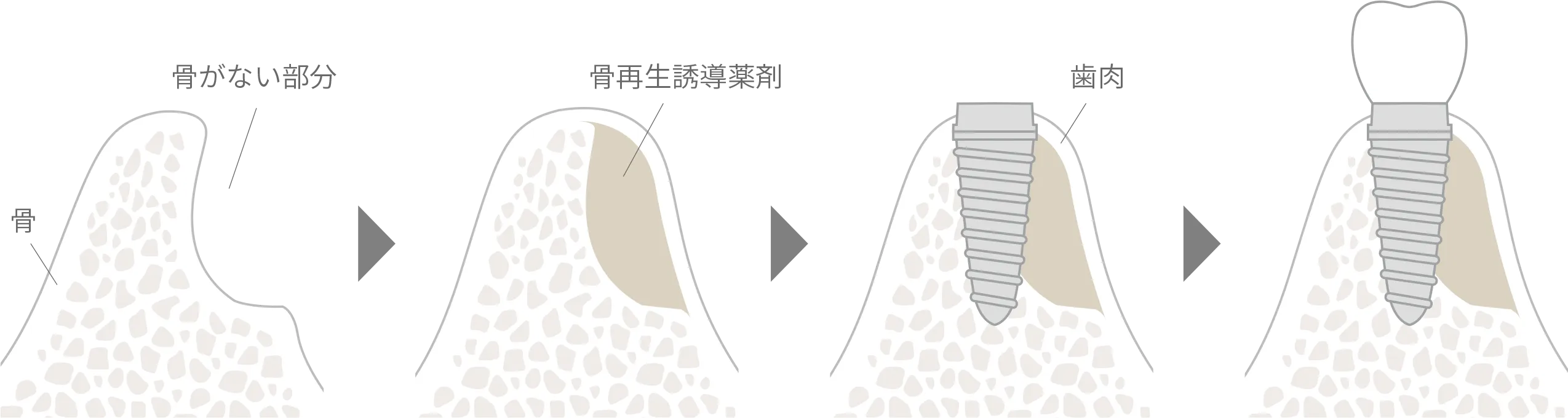 GBR治療の流れ