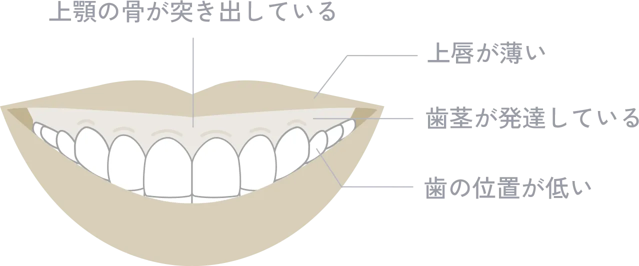ガミースマイル